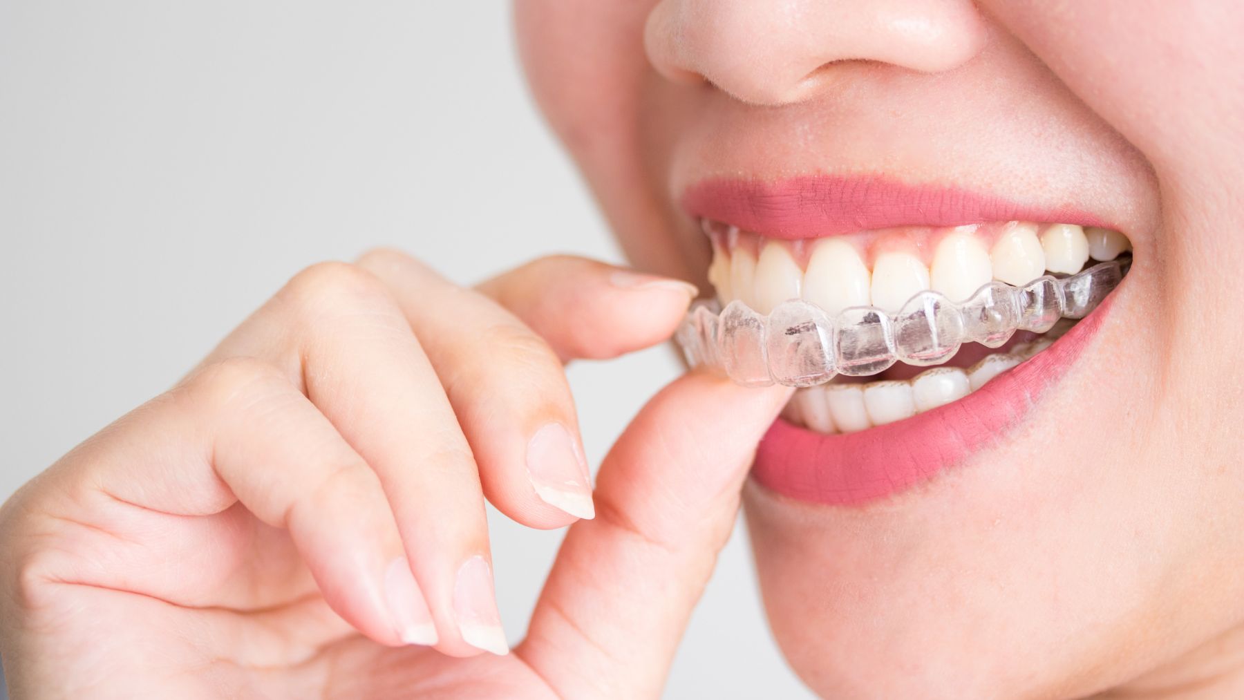 Aparat nakładkowy Invisalign katowice