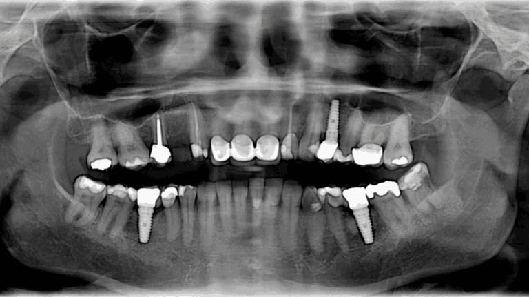 leczenie implantami jak wygląda