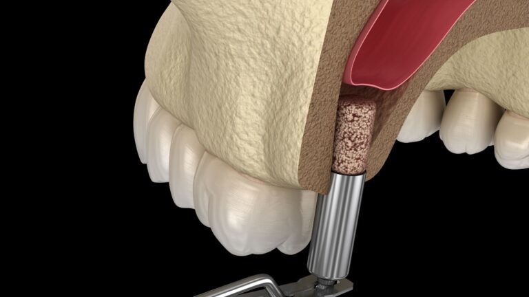 Sinus lift Katowice